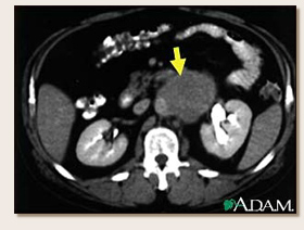 Lymph Node Metastases, CT Scan